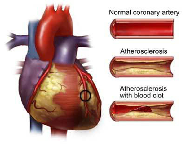 Heart Disease EatWellandBeyond